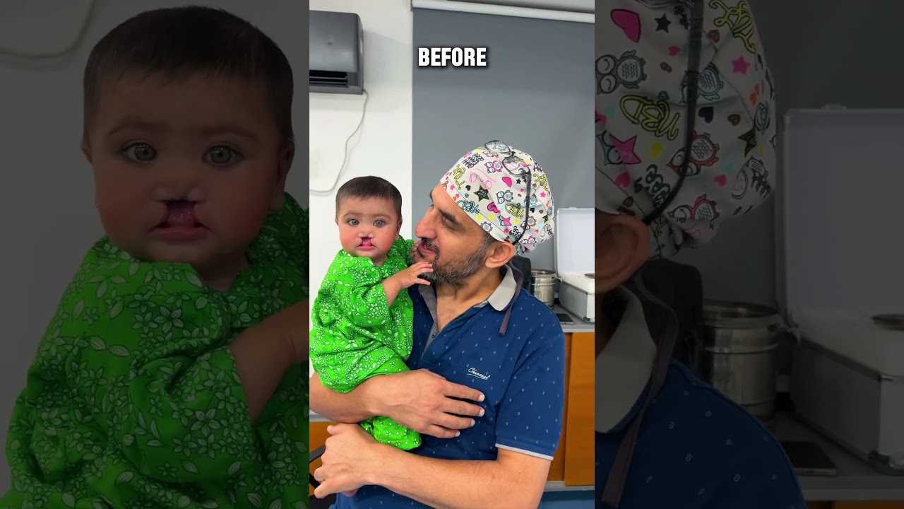 ✨Free Cleft Lip & Palate Surgery👄✨Before | After Result🤩🥰Dr. Habib's clinic👨🏻&zwj;⚕️🏥