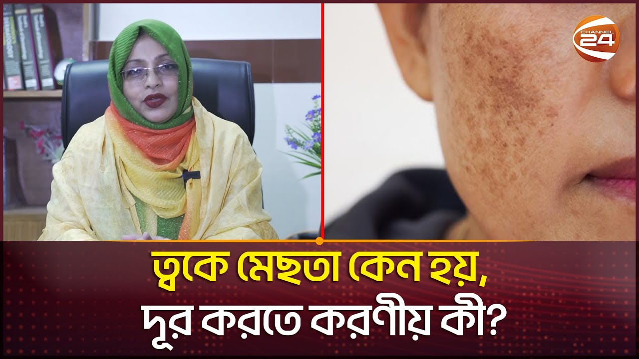 ত্বকে মেছতা কেন হয়, দূর করতে করণীয় কী? | Skin roughness | Channel 24