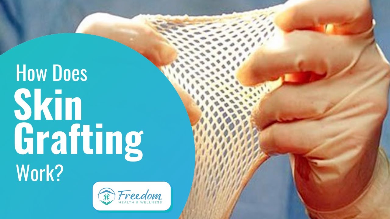 How Does Skin Grafting Work? - Martin Schnell, MD