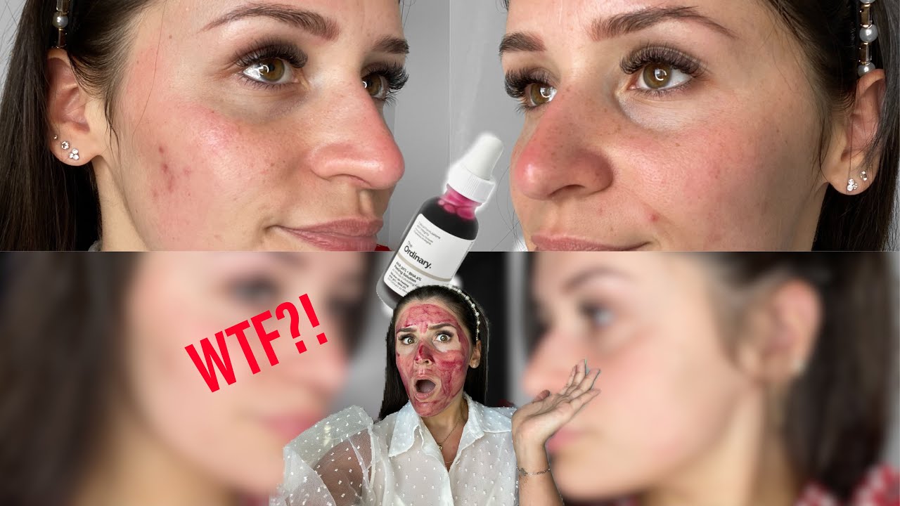 JE TEST LE PEELING THE ORDINARY PENDANT 1 MOIS