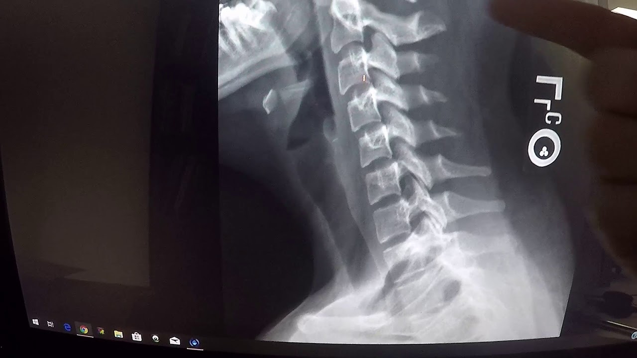 How to look at an x ray (MILITARY STRAIGHT NECK)