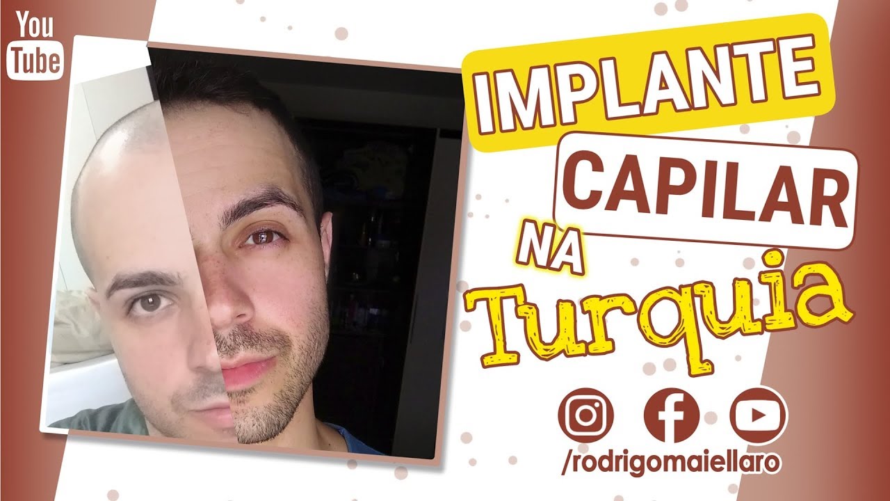 IMPLANTE CAPILAR NA TURQUIA (PARTE I) - Rodrigo Maiellaro