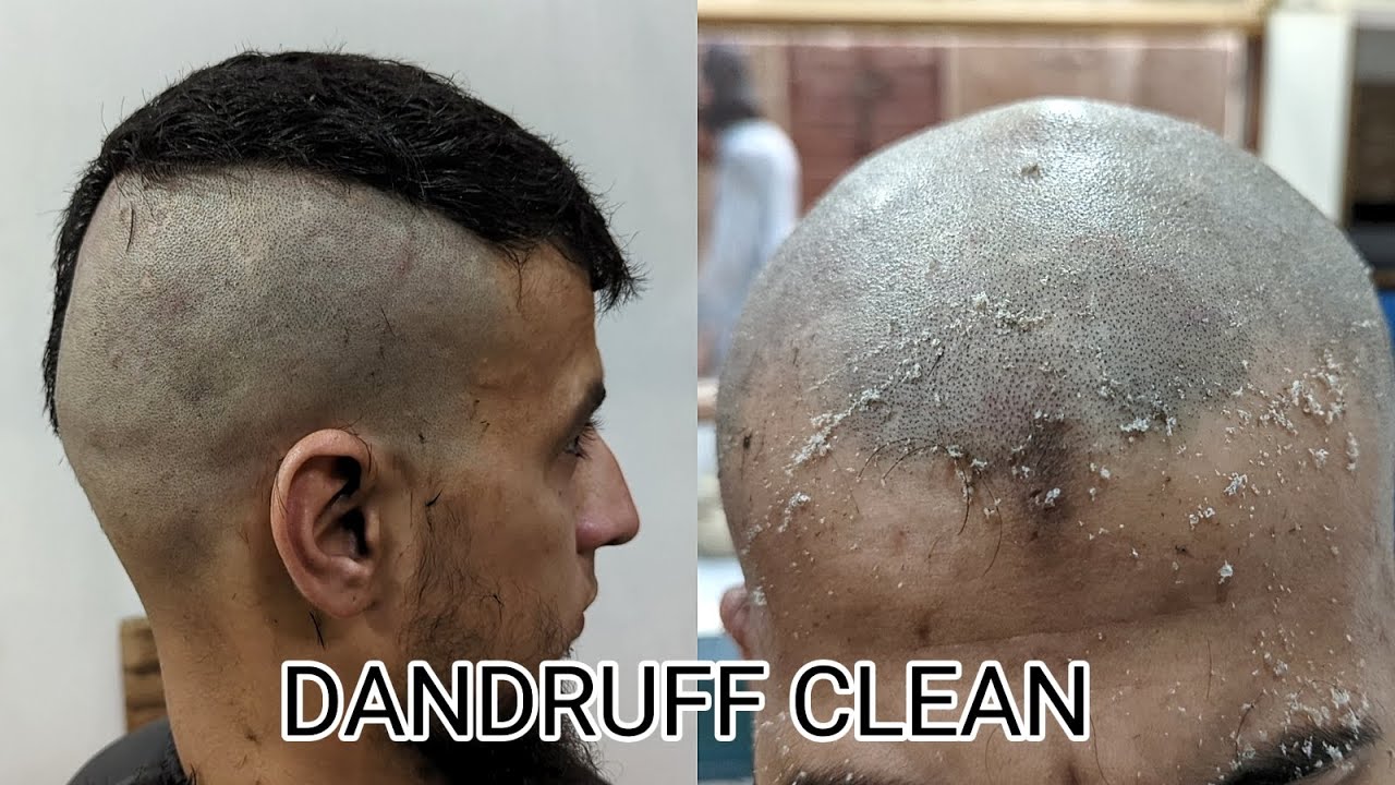 Attractive dandruff clean head shave straight razor,how to remove dandruff in hair zaibi barber shop