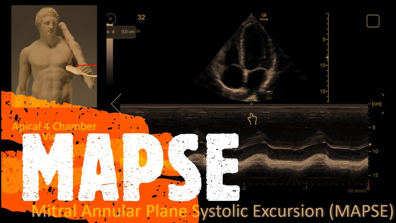 Measure MAPSE. Perioperative & Critical Care ECHO / POCUS