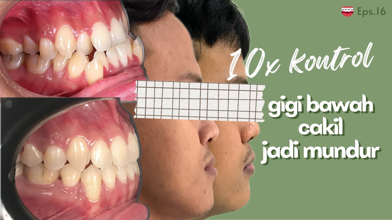 10x Kontrol, Gigi Bawah Cakil Jadi Mundur. Eps.16
