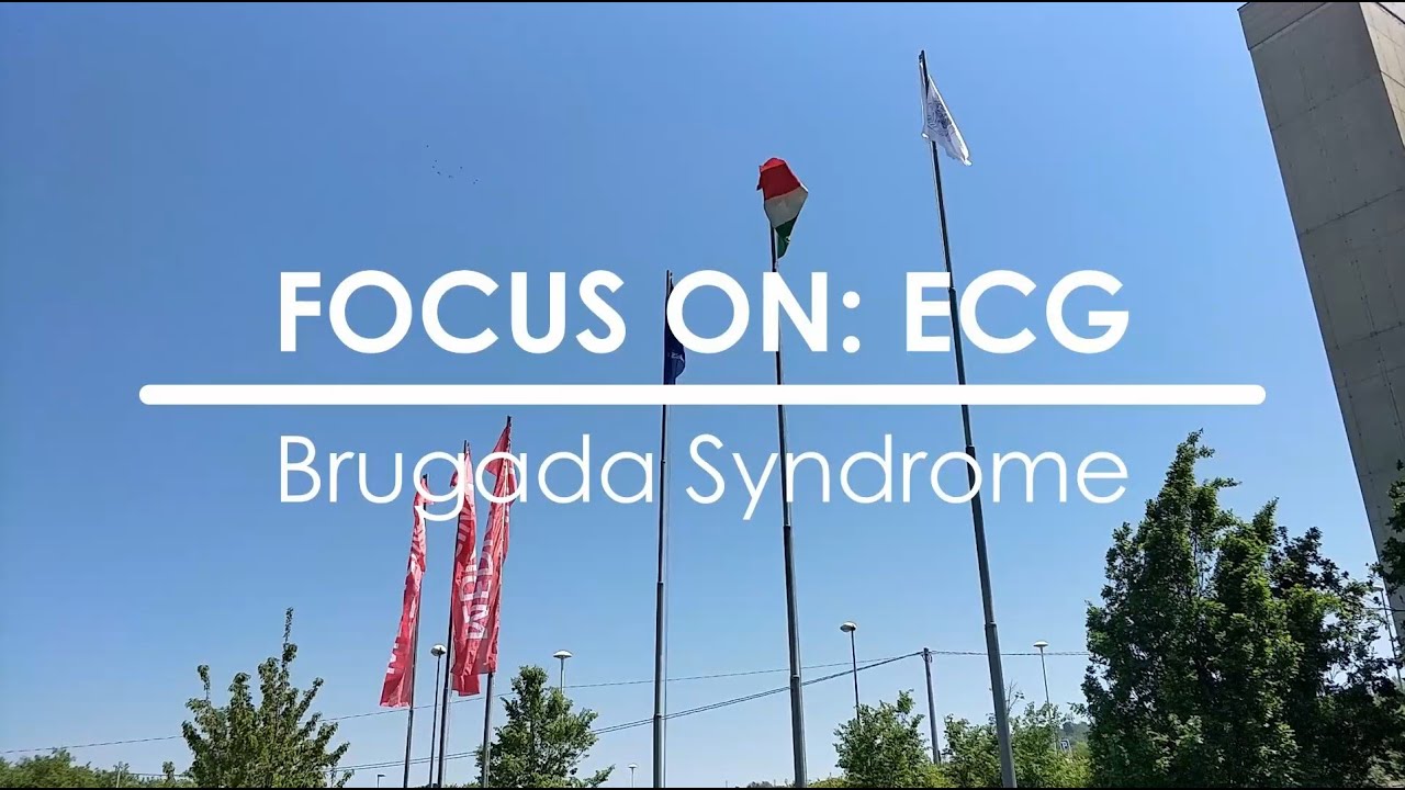 Focus on ECG: Brugada syndrome