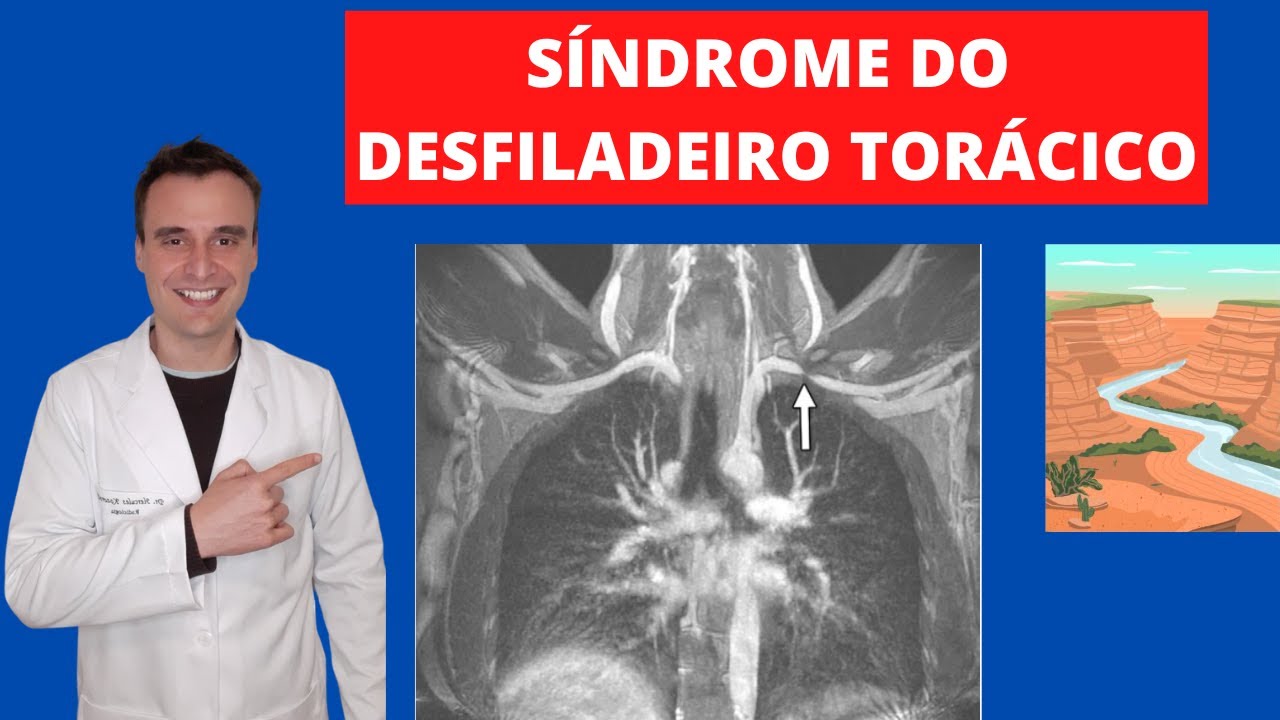 Tudo sobre síndrome do desfiladeiro torácico