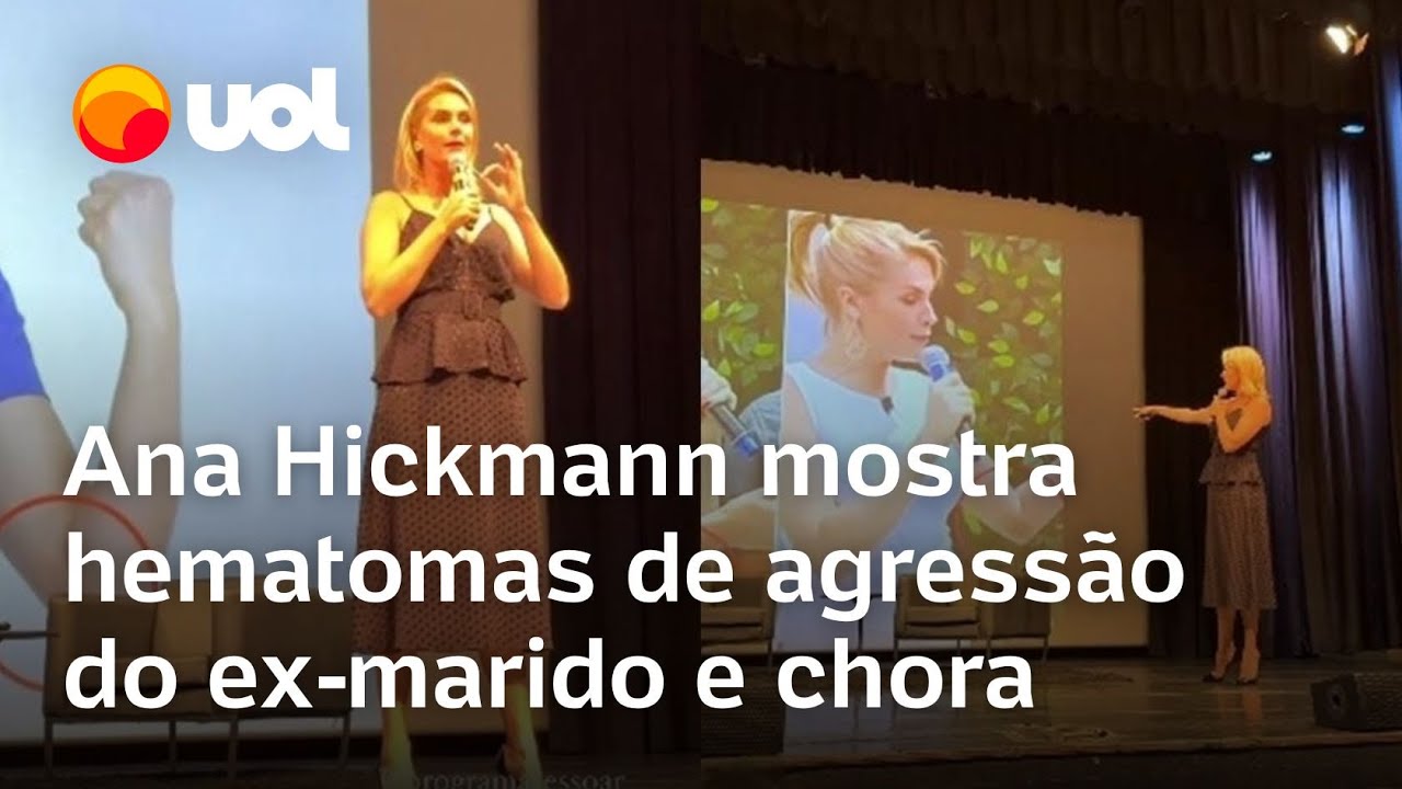 Ana Hickmann mostra hematomas após ser agredida pelo ex-marido Alexandre Correa; veja vídeo