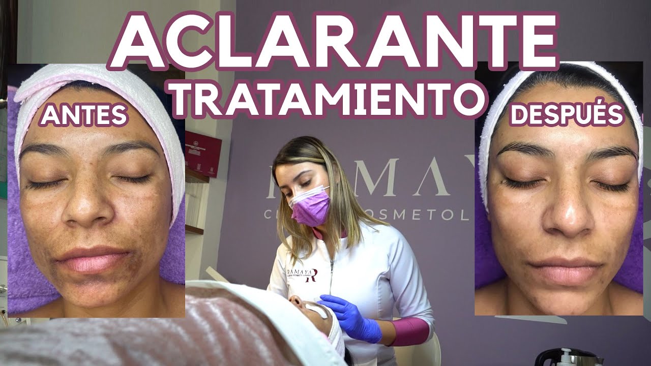 CÓMO QUITAR LAS MANCHAS | TRATAMIENTO - Ximena Ramana