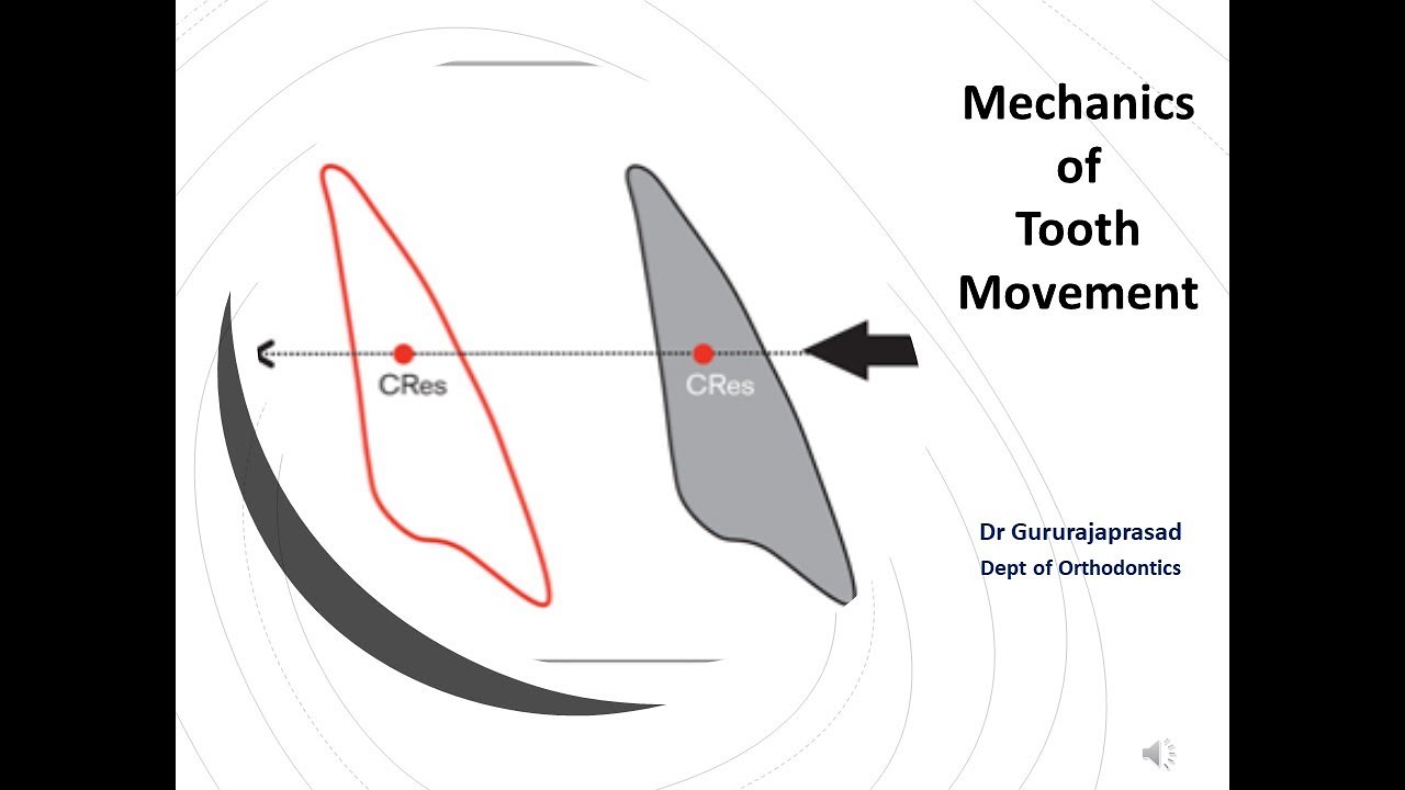 Mechanics of Tooth Movement