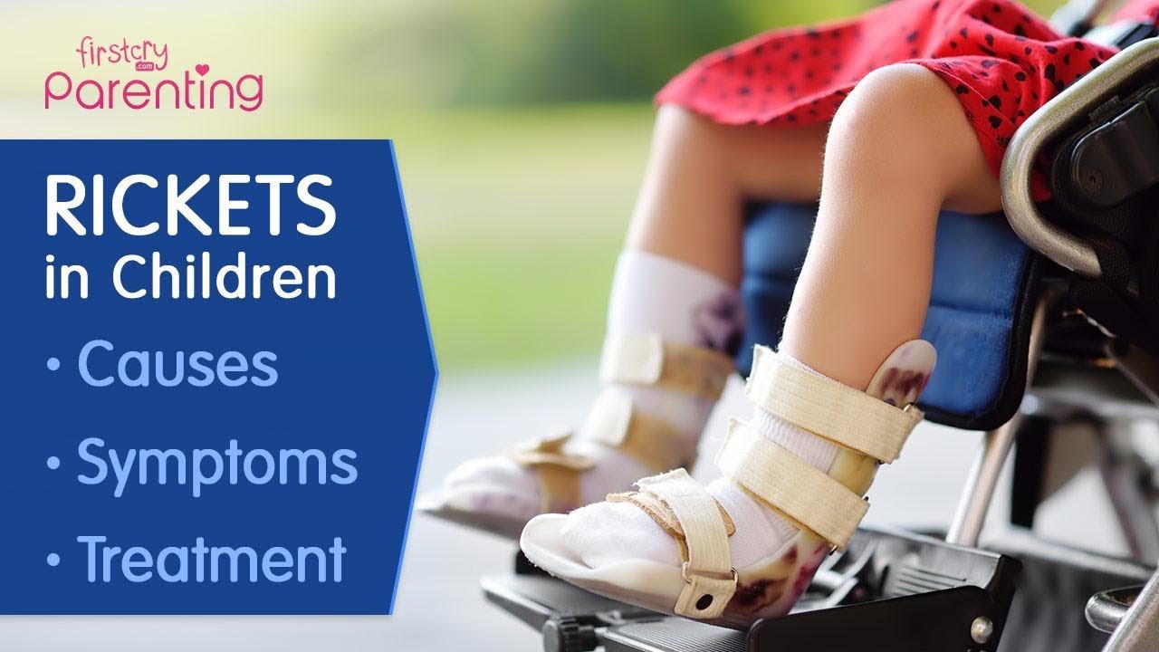 Rickets in Children  -  Causes, Symptoms and Treatment