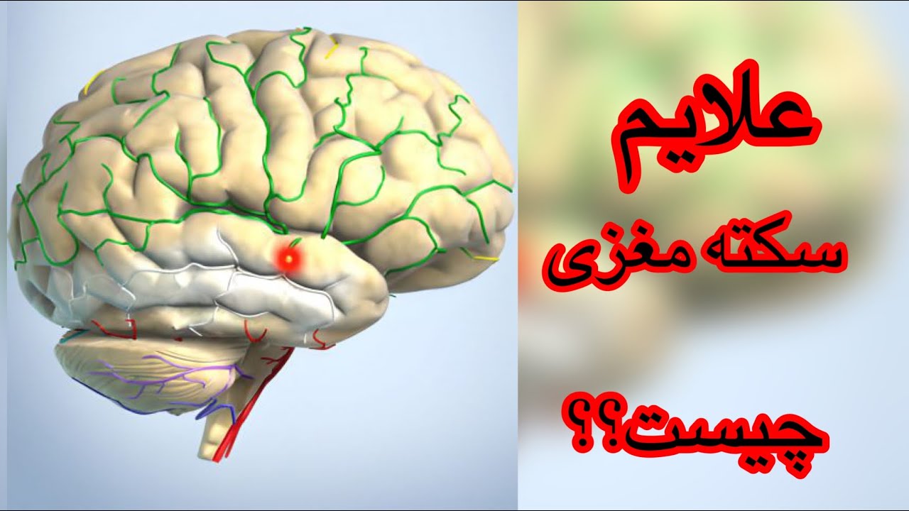 علایم سکته مغزی چیست؟مشکلات قلبی چه ارتباطی با سکته مغزی دارد؟