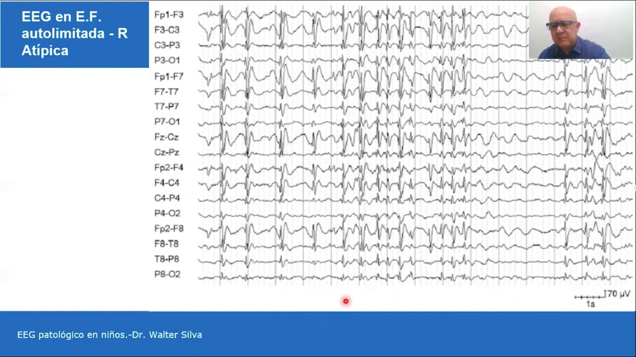 EEG PATOLOGICO EN NIÑOS