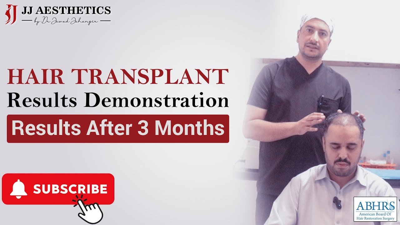 Hair Transplant Miracle: Stunning Results in Just 3 Months! JJ Aesthetics