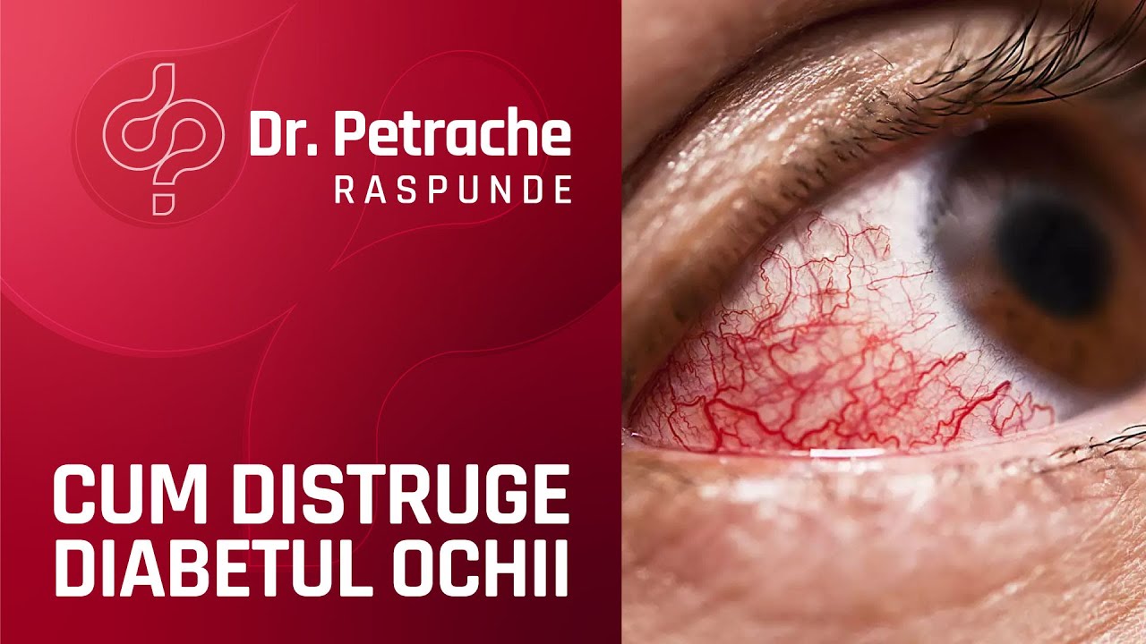 Afla CUM iti DISTRUGE Diabetul OCHII