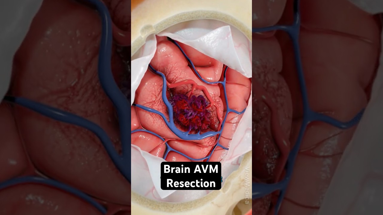 AVM: Bleeding in your brain (3D Animation)