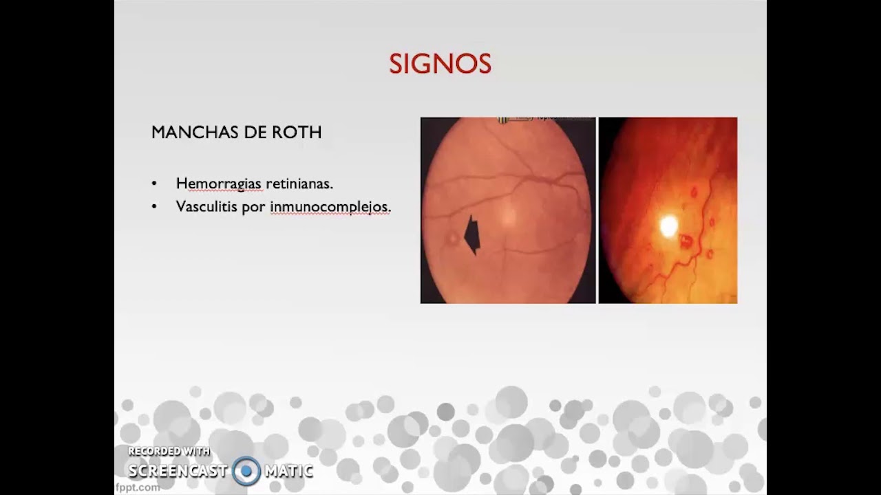 Seminario Endocarditis. Dra. Mariana Martino.