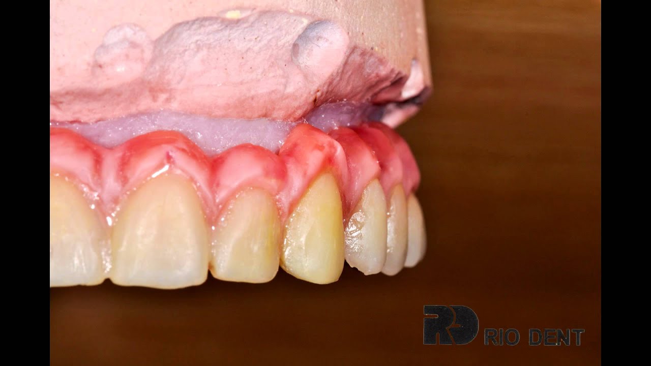 Ceramage encia , puente y caracterización mitad de protesis muestra