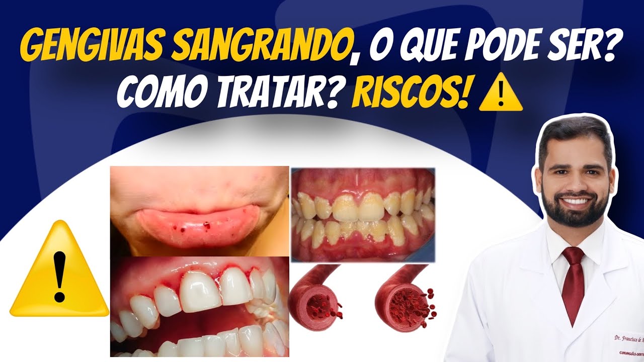 Gengivas sangrando: O que pode ser? Como tratar? Riscos! ⚠️ #sangramento #gengiva #hiv