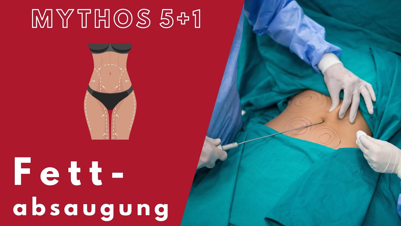 5 + 1 FAKTEN UND MYTHEN ÜBER FETTABSAUGUNG | Praxisklinik am Rosengarten