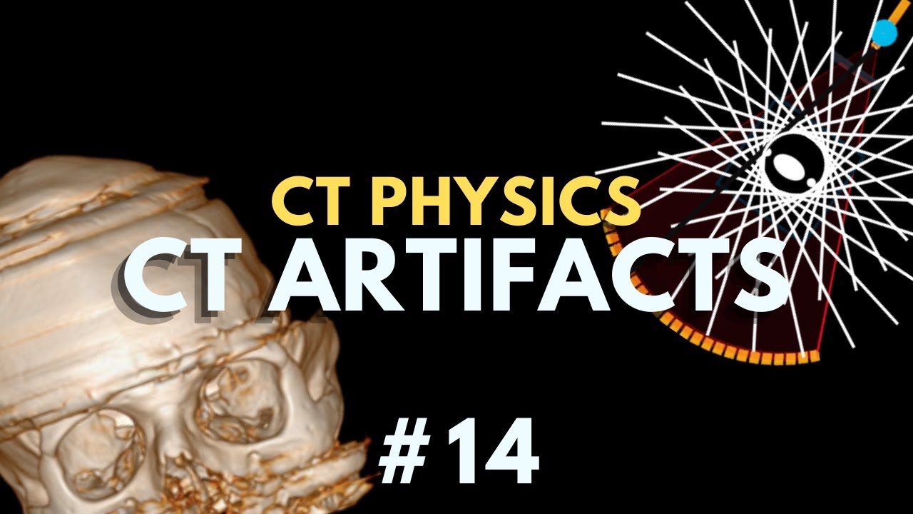 Common CT Artifacts | Computed Tomography Radiology Physics Course #14