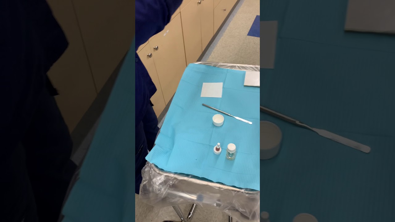 Glass Ionomer: Ketac-Cem Luting