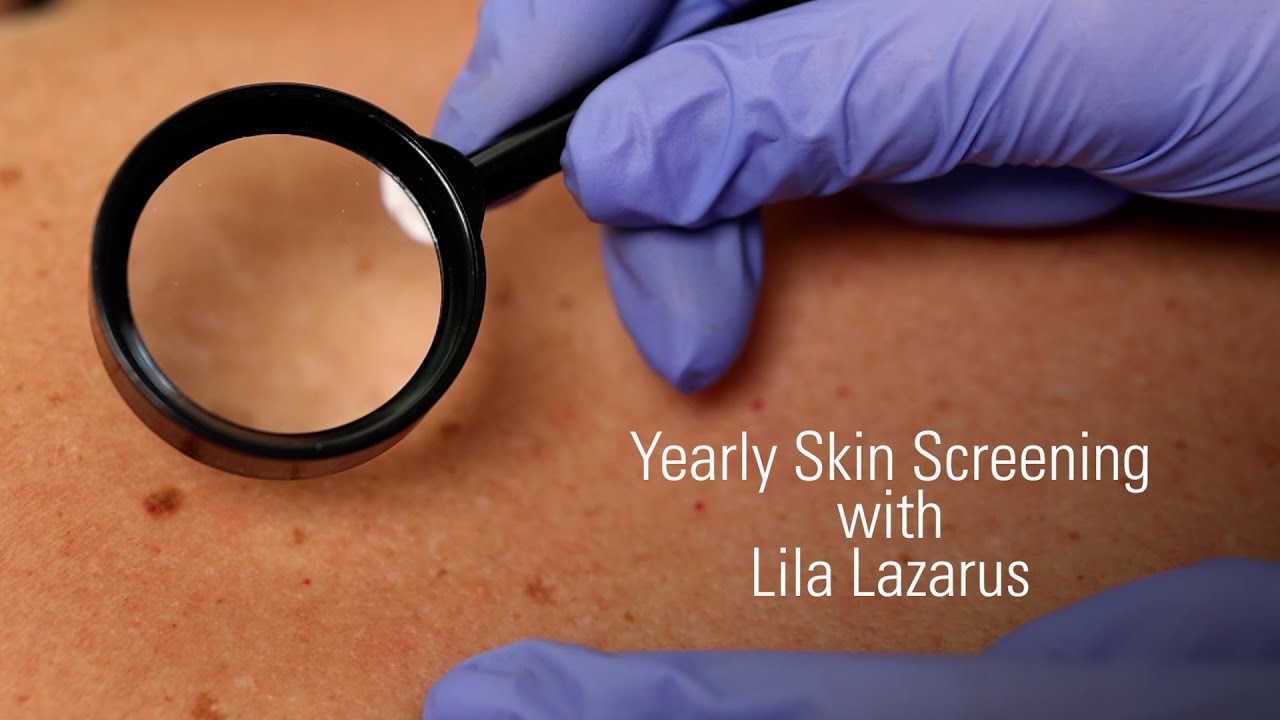Annual Skin Cancer Screening: What to Expect