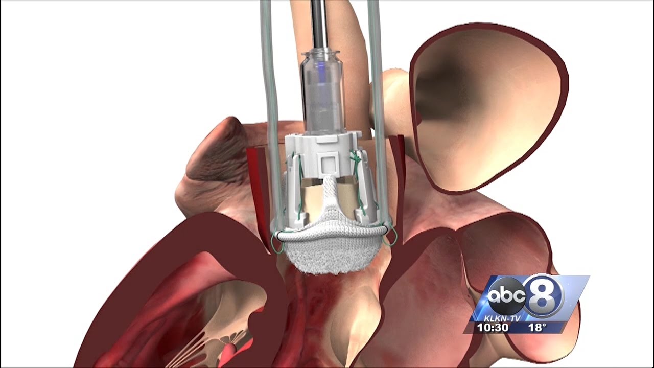 Second Sunday Bryan Health Report: Edwards Intuity Valve