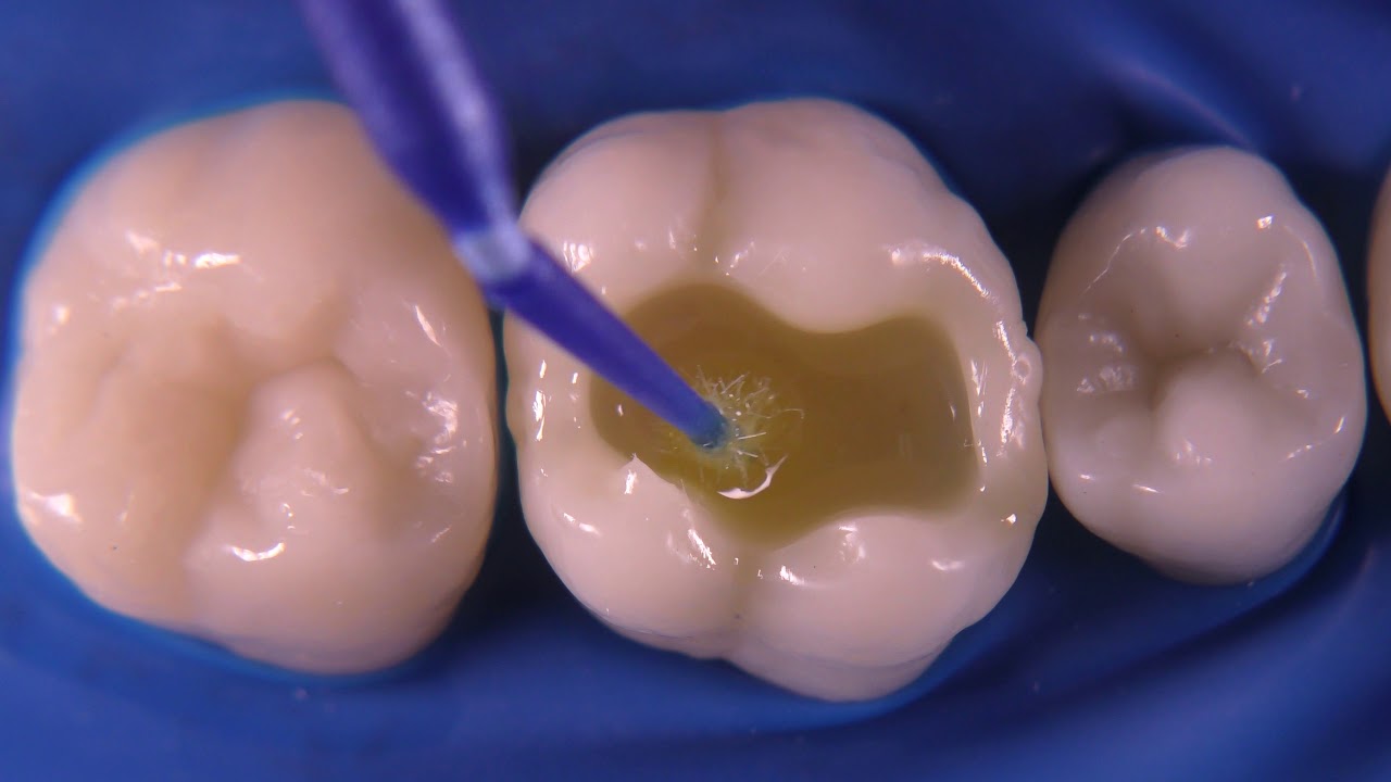 three step etch and rinse adhesive