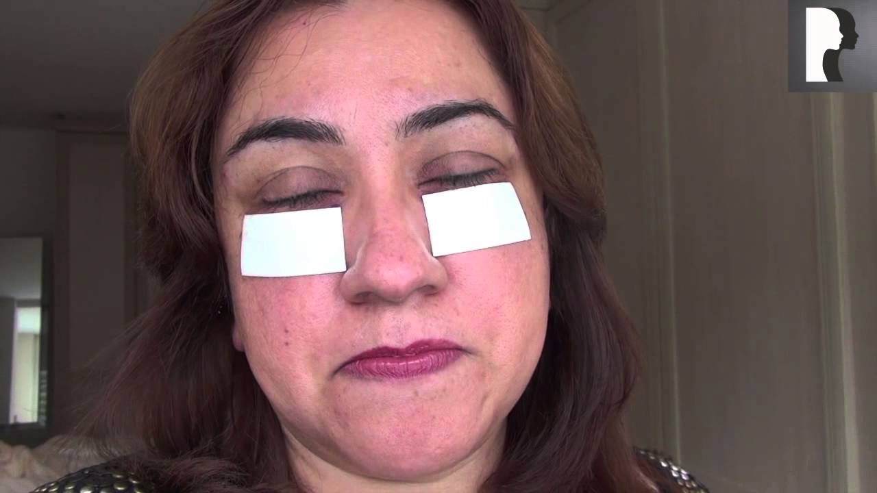 Blepharoplasty Video Diary: Day 1 After Surgery & Recovery Progress