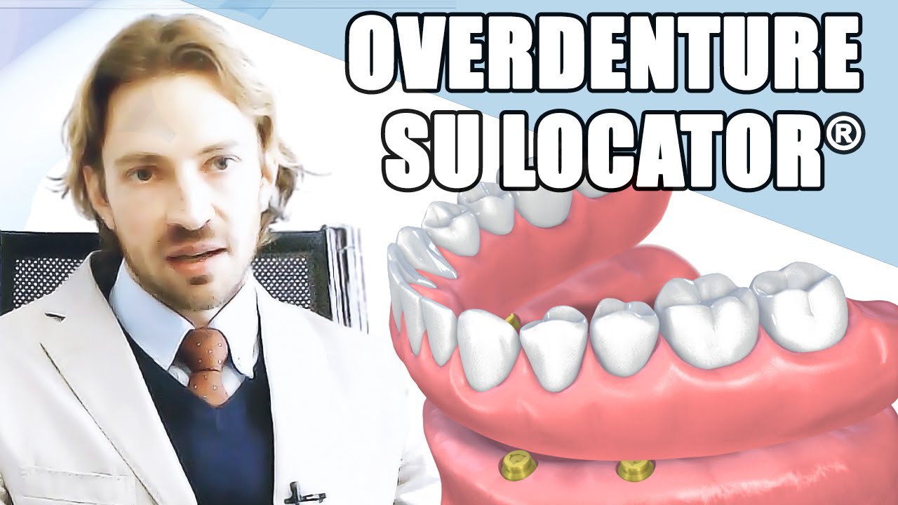 L'Overdenture su Locator® (protesi su attacchi) [HD]