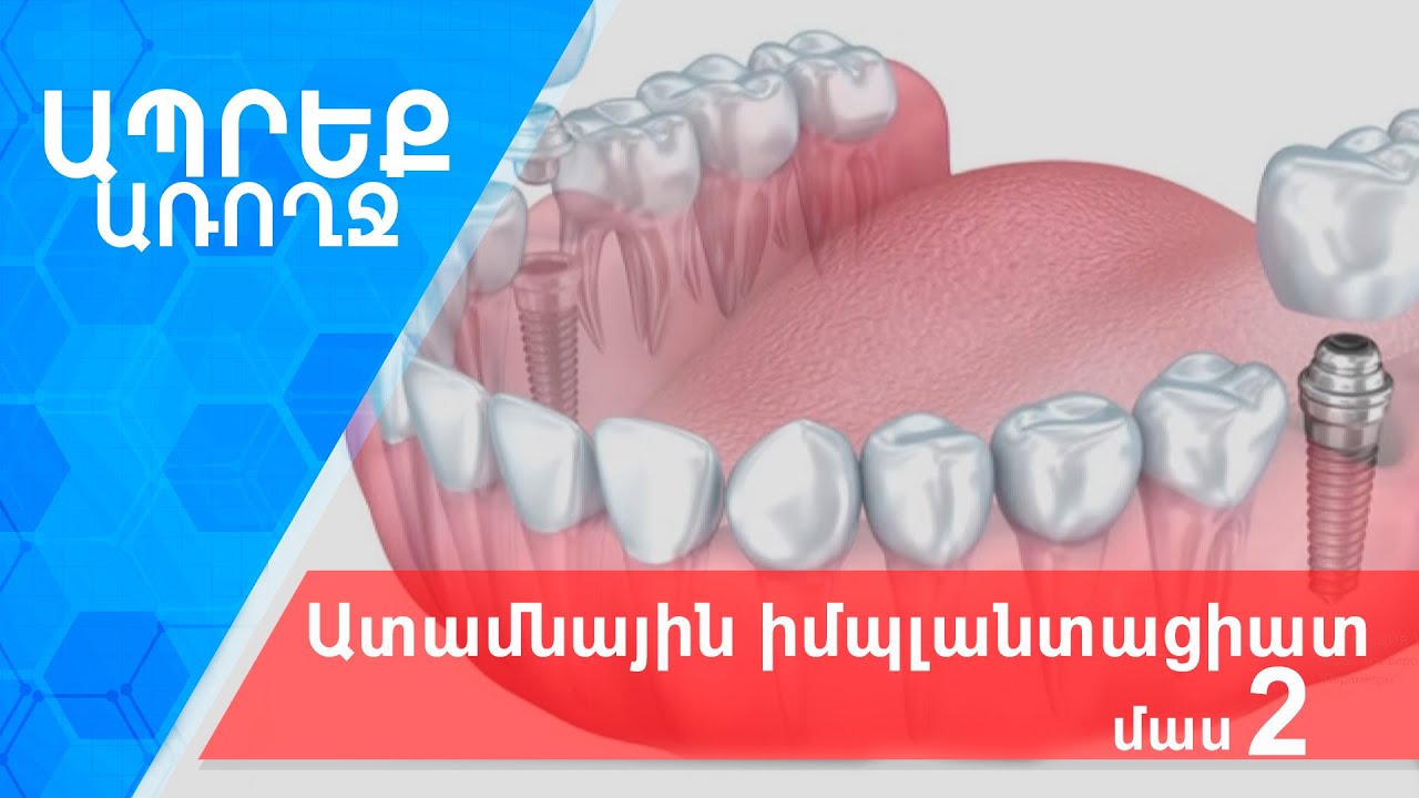 Ապրեք առողջ I Ատամնային իմպլանտացիա,  մաս 2