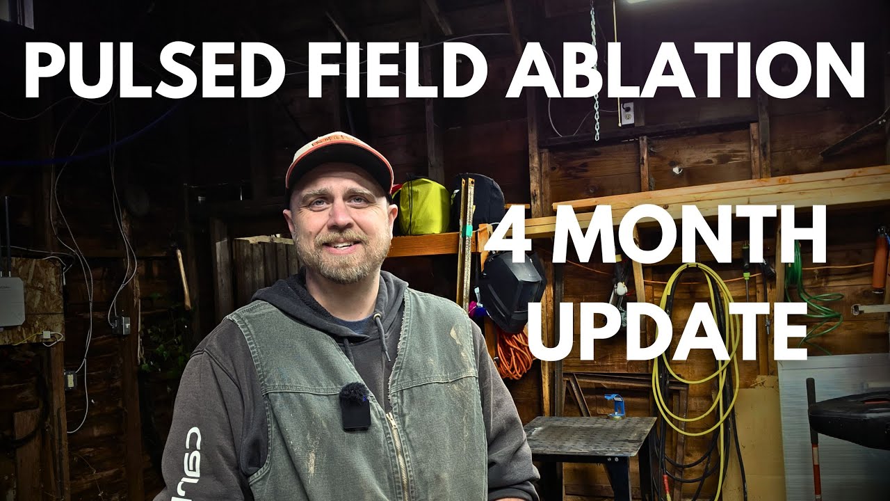 4 Months After a Pulsed Field Ablation - AFIB, Ectopic Heartbeats, Anticoagulants