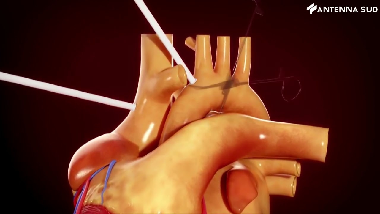 24 Maggio 2022 - Bari, trapianto di cuore n.100 al policlinico