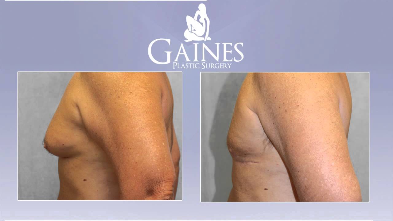 Male Breast Reduction - Gainesville - Gaines Plastic Surgery