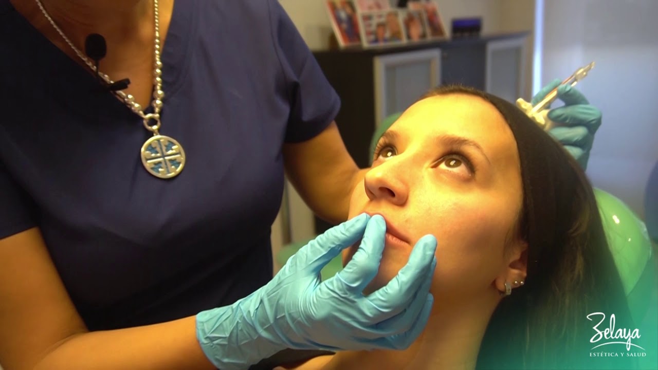 Perfilado y Voluminización de Labios con Acido Hialurónico