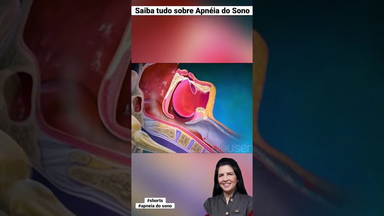 O que &eacute; a Apneia do Sono? Tipos e Classifica&ccedil;&atilde;o #dentist #shorts #dental #bruxismo #apneia #