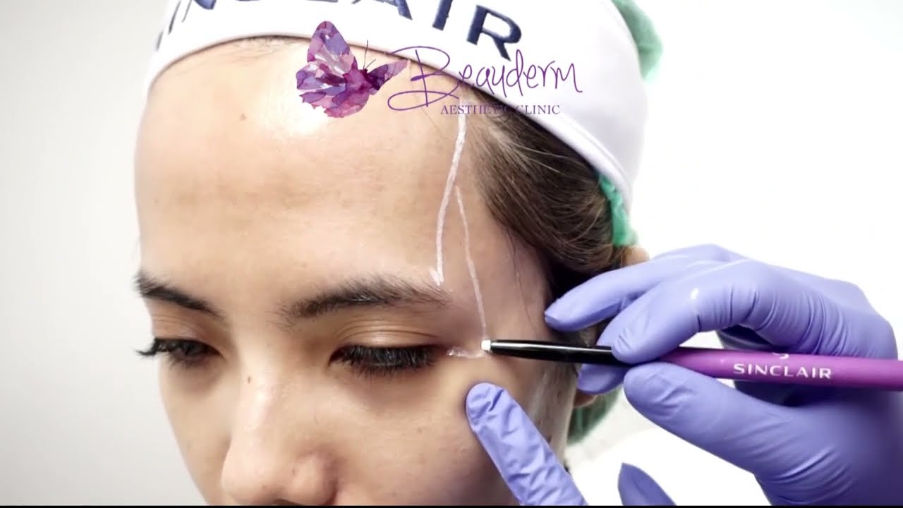 Mengurangi Memperbaiki Kerutan Area Pelipis Cekung (Proses Suntik Filler Temporal)