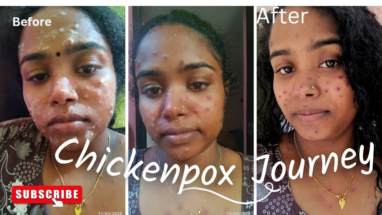 Story of my chickenpox days🥺🥲അൺസ ഹിക്ക day😥 