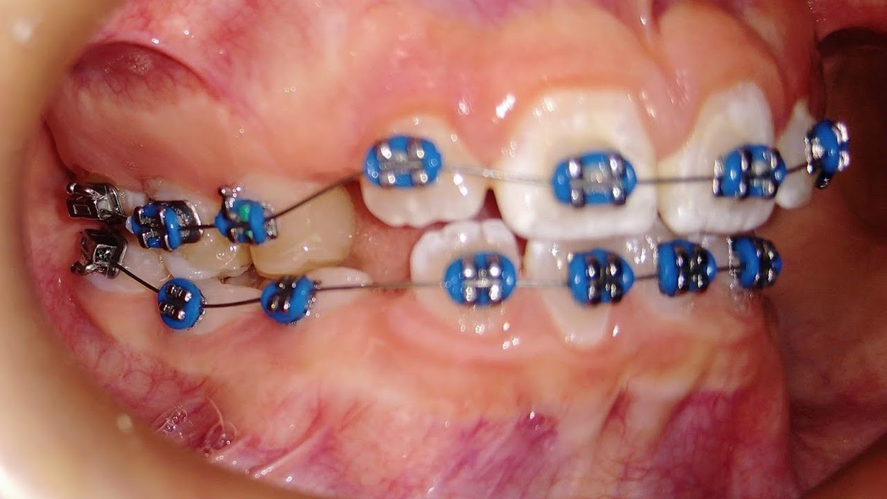 ¿Se puede colocar brackets en dientes de leche?? 😎🤯 En pacientes jóvenes??👀