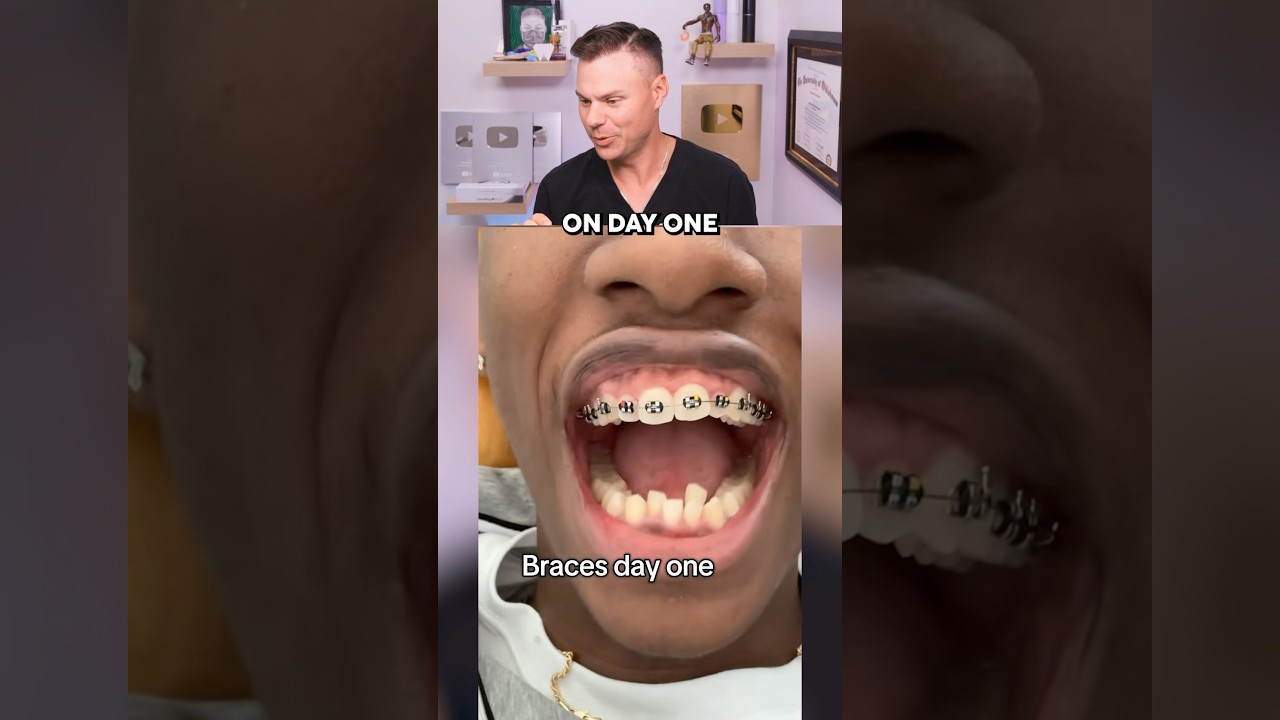 This Braces Transformation Is CRAZY! 😮🦷