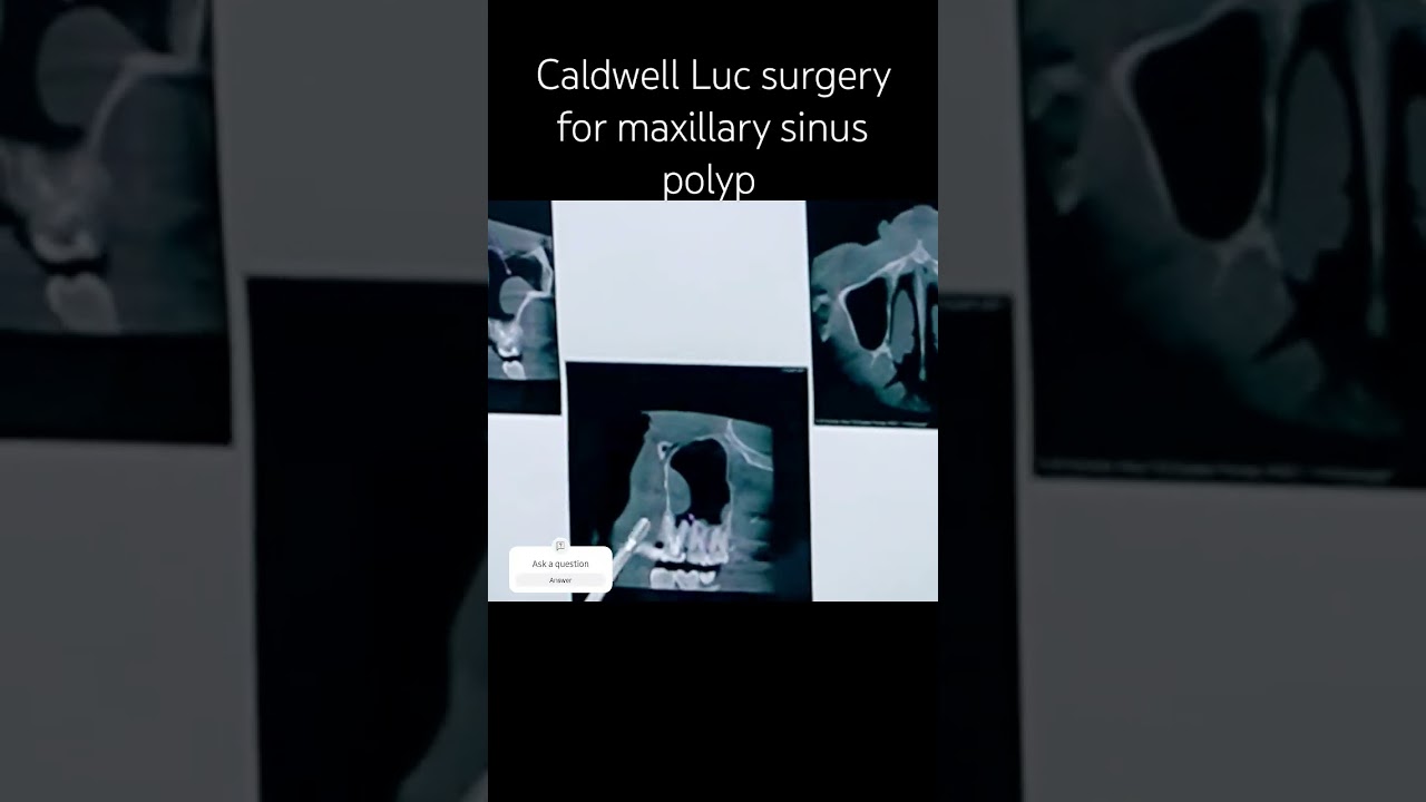 Maxillary Sinus Polyp Surgery by Oral and Maxillofacial surgeon: Precision and Care in Action