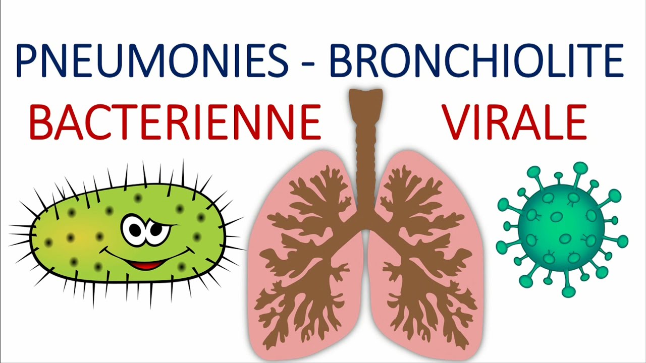 Comment différencier entre une pneumonie aigue communautaire bactérienne et virale atypique?