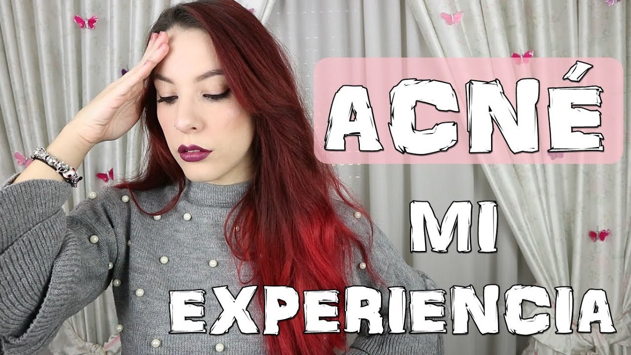MI EXPERIENCIA CON EL ACNÉ | COMO ELIMINARLO, TRATAMIENTO... ROACUTÁN ¿SÍ O NO?