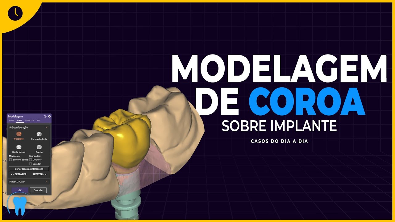 EXOCAD : Coroa anatômica aparafusada