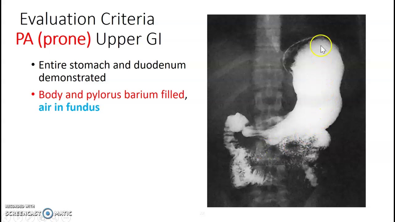 Upper GI