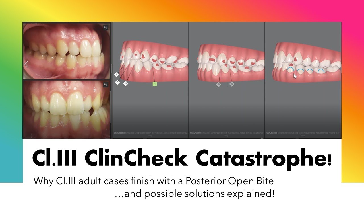 Invisalign ClinCheck - Cl.III case problems & how to solve Posterior Open Bite