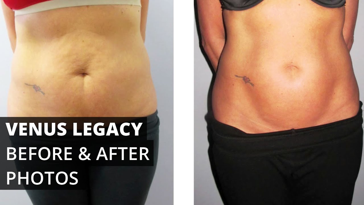 Venus Legacy&trade; Before & After Photos