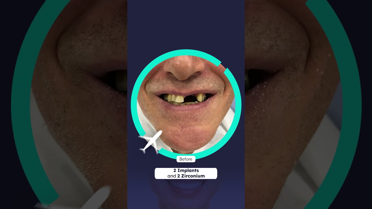 2 Implants And 2 Zirconium