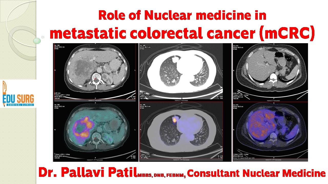 Role of PET scan/ Nuclear Medicine in the management of stage IV colon cancer and rectal cancer